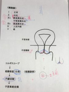 LEEPによる子宮頸部円錐切除術メモ