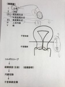 LEEPによる子宮頸部円錐切除術メモ
